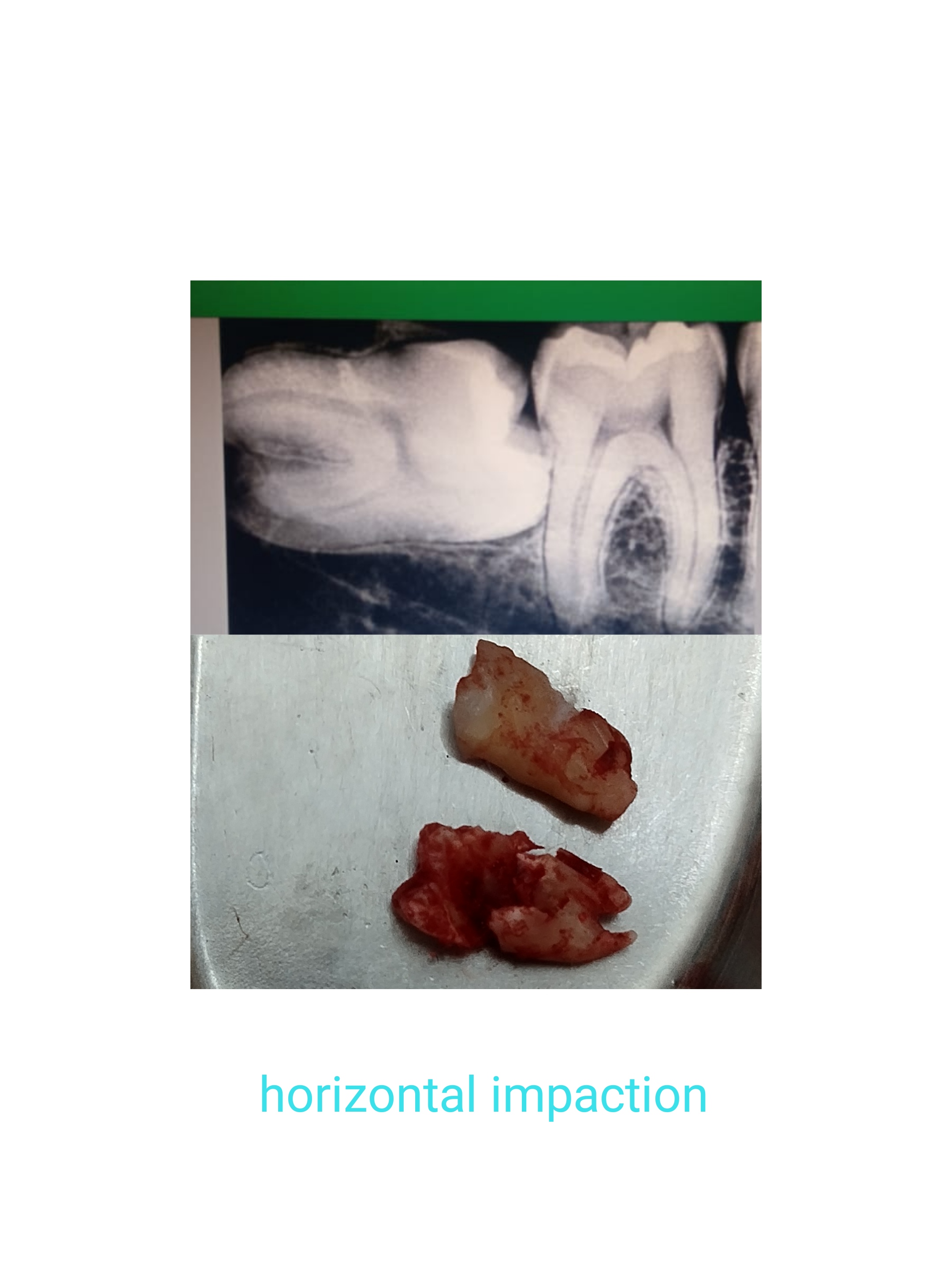 Impaction