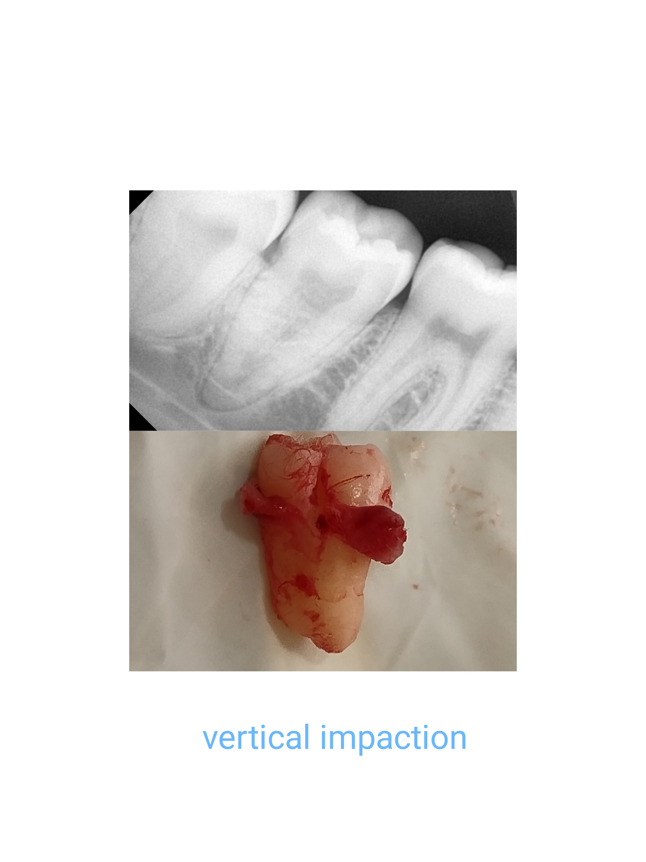 Impaction